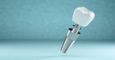 Implante de dente